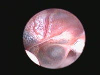 крупный полип носоглотки