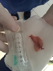 удаленный полип